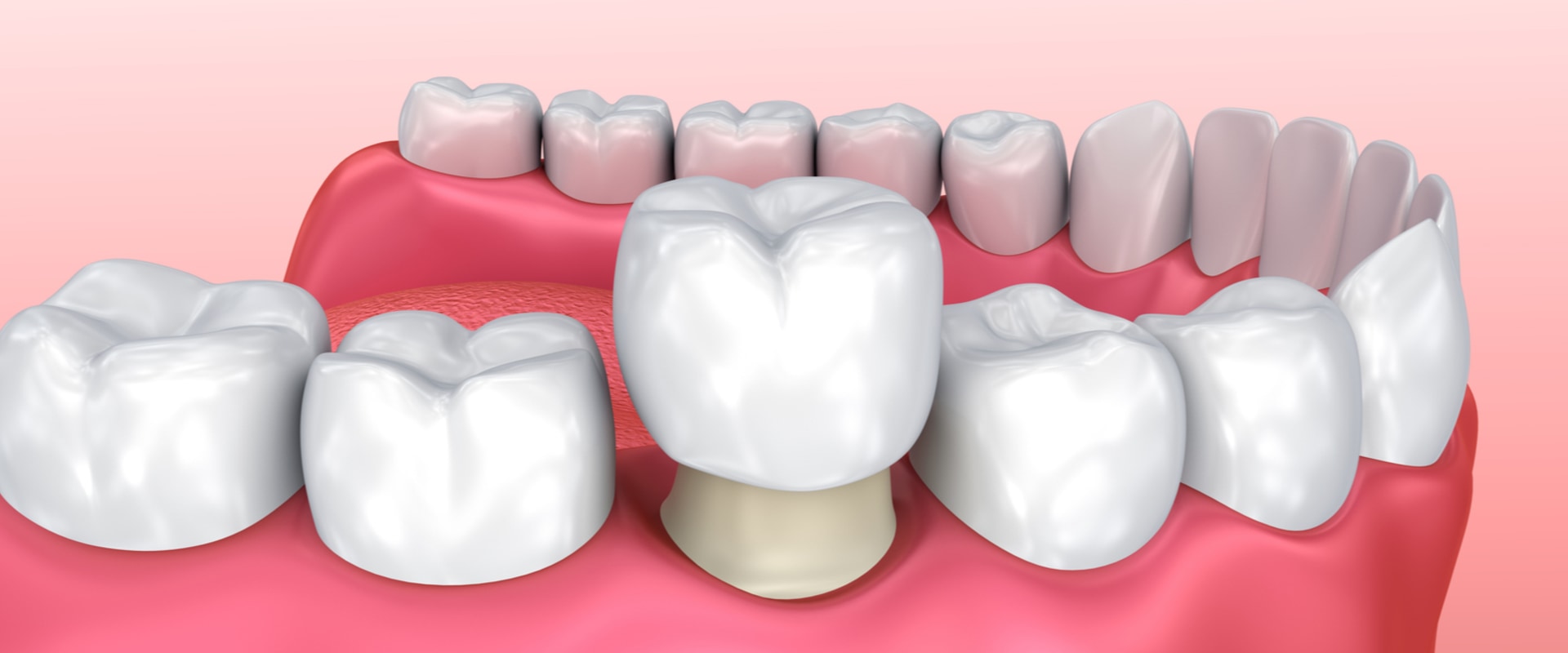What Kind of Dentist is Best for Crowns?