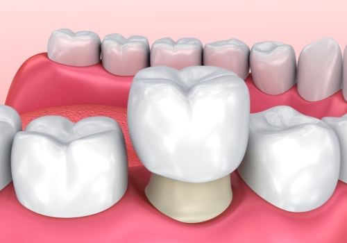 What Kind of Dentist is Best for Crowns?
