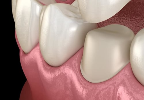 What Type of Dentist is Best for Crowns?